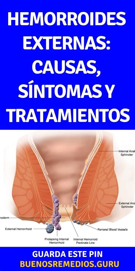 hemorroides externas fotos|Hemorroides externas [almorranas]: qué son, síntomas y cómo。